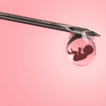 IVF Lite for Women with Endometriosis